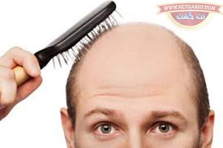 علل و عوامل تاسی سر و ریزش مو در طب سنتی